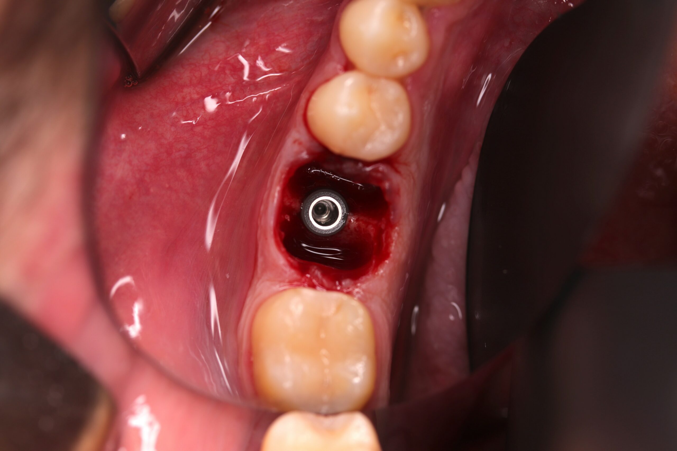 Figure 1 Immediate implant placement in fresh extraction shocket