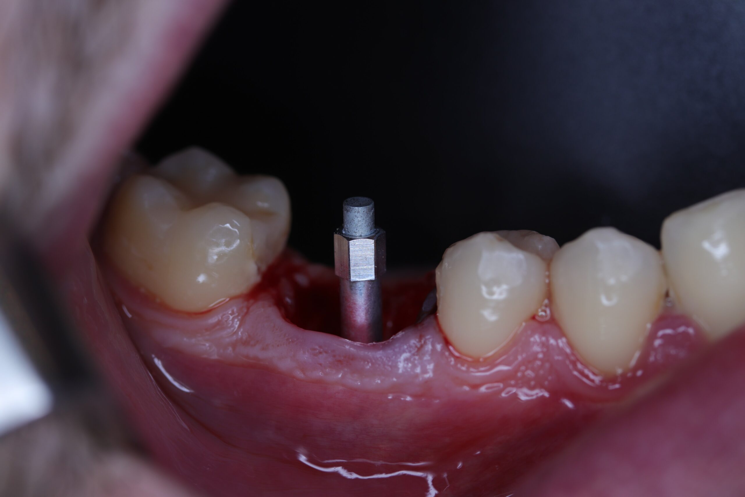 Figure 4 Smart-peg (Type 16) screwed to the implant platform