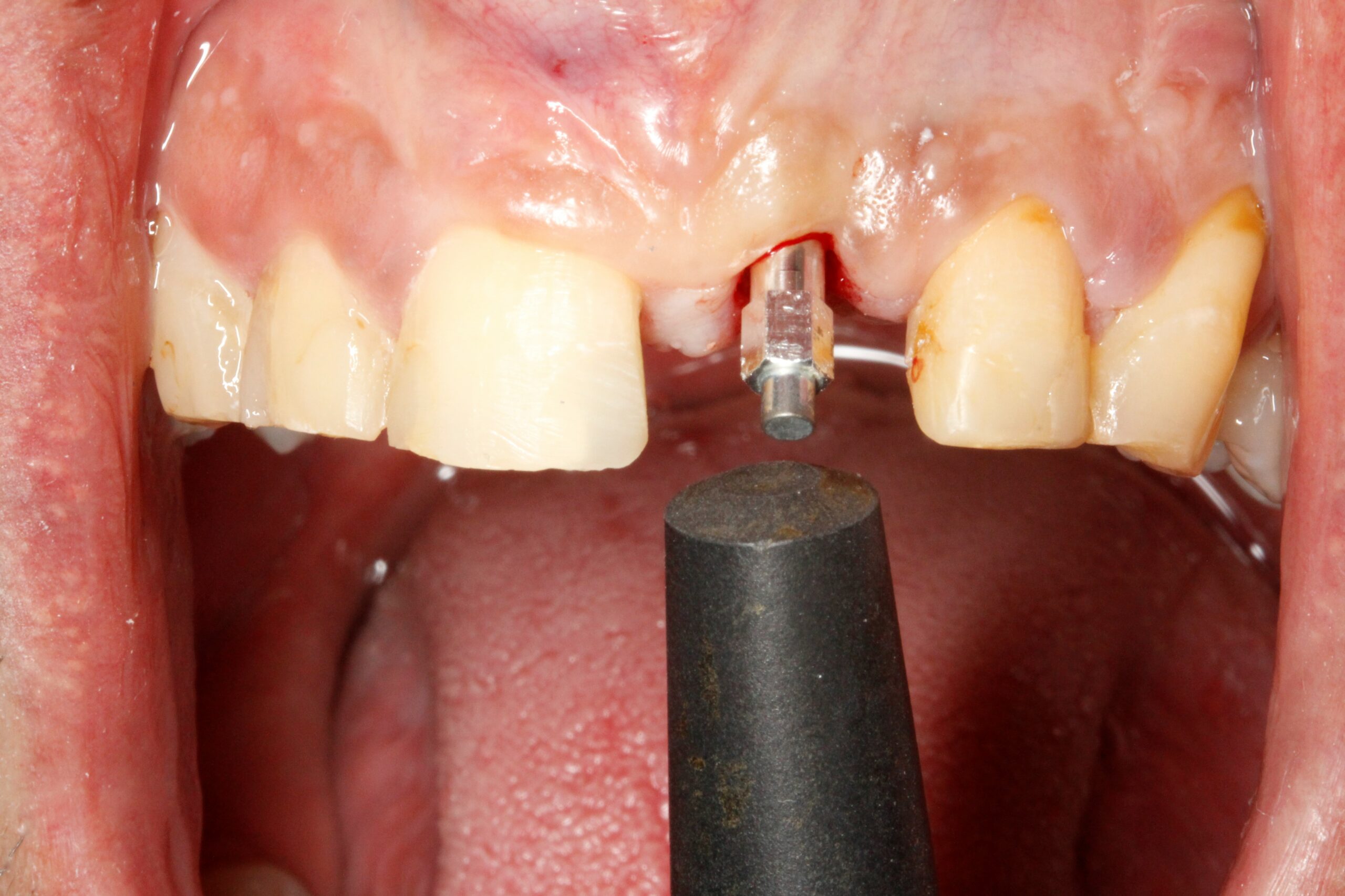 Figure 5 The position of the device must be kept orthogonal and 3 mm from the abutment to get significant results.