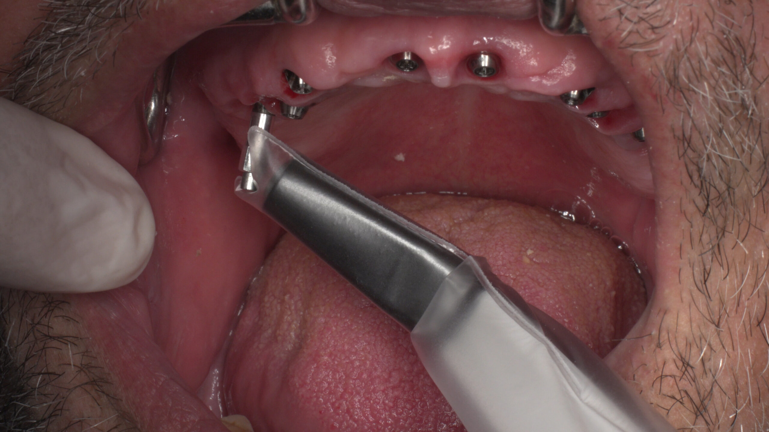 How to measure Osstell ISQ on abutment