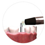 Objectively assess Implant Stability with RFA