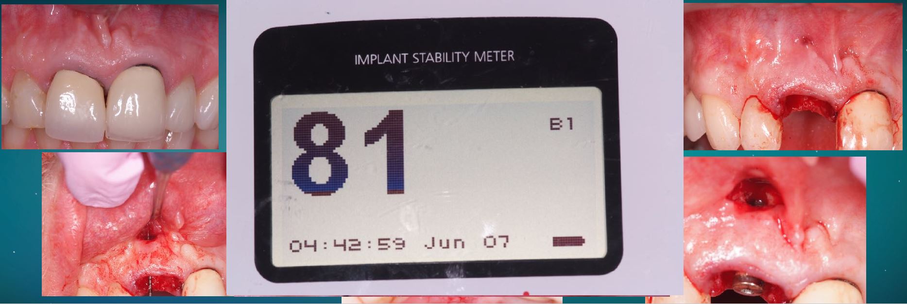 Immediate temporisation and/or loading, is this a safe environment for the biology?