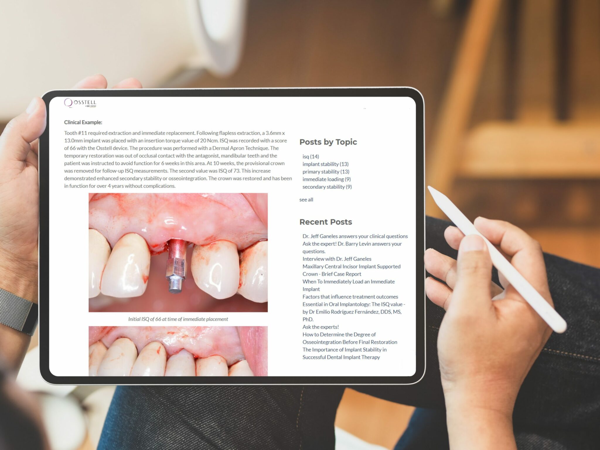 The most read pieces of 2019 compiled Osstell®